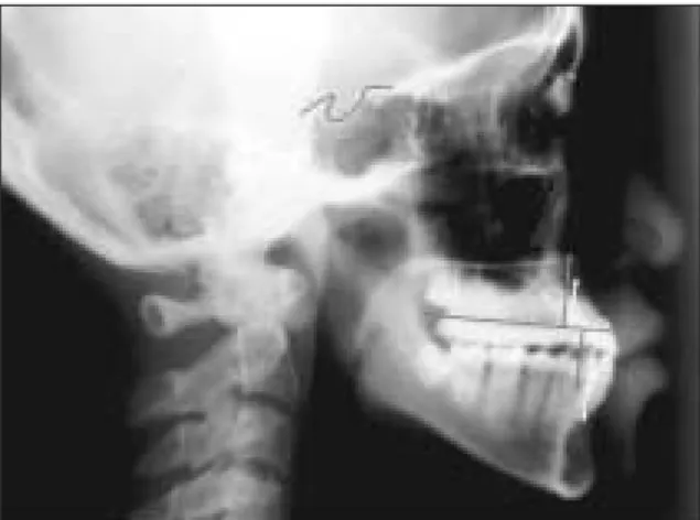 Fig. 4. Bite가 깊으며 교합시 midline이 deviation  된다.
