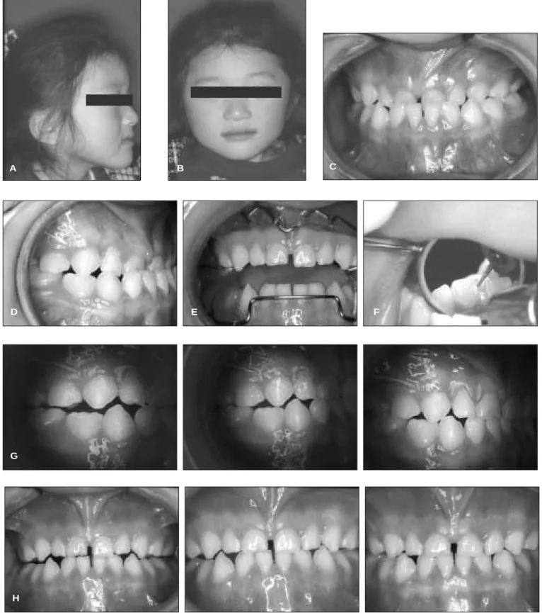 Fig. 7. A, B : Profile이 약간 prognathic하여 골격적 소인이 있으나 가족력은 없음. 두부방사 선계측사진에서 ANB가 0을 보임.
