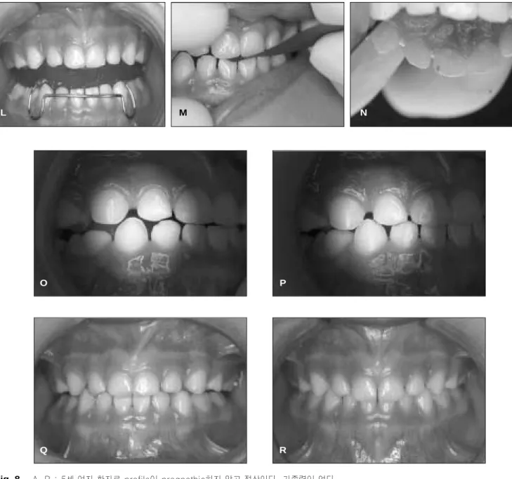 Fig. 8. A, B : 5세 여자 환자로 profile이 prognathic하지 않고 정상이다. 가족력이 없다. 
