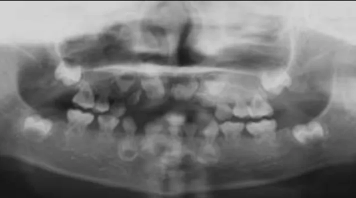 Fig. 4. Fusion  between  #81  and  #82.  Congenital  missing of #51 and #61. Oligodontia in permanent dentition.