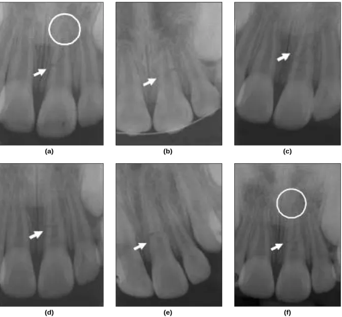 Fig. 1. Case 1, (a) X-ray at first visit, (b) 1 month later : EPT (+), Mo(-), (c) 3 months later : EPT (+), Mo (-), (d) 6 months later : EPT (+), Mo (-), (e) 1 year later (formation of calcium barrier), (f) 2 years later (root development completed).