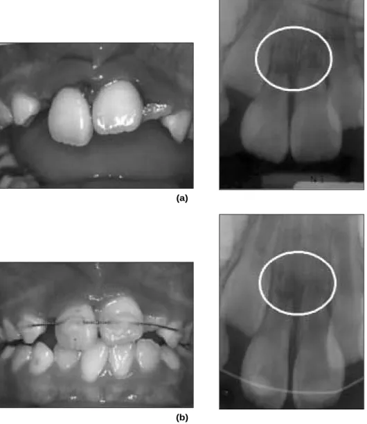 Fig. 3. (a) first visit, (b) after splinting