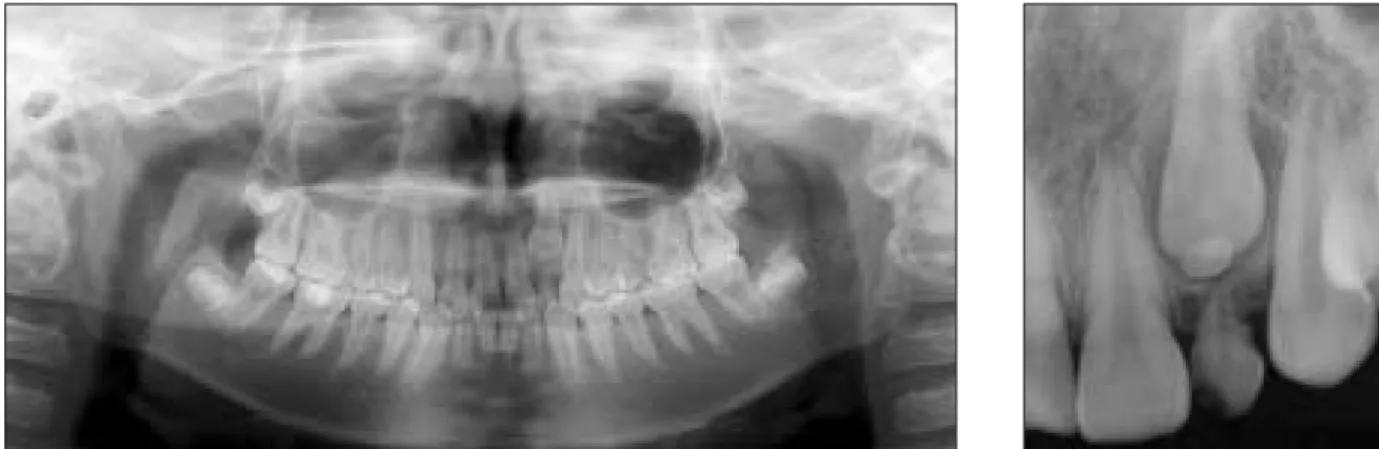 Fig. 1. Initial  panoramic  and  periapical  view  showing  a  delayed  eruption  of  #62,  impacted  tooth  on  #22  and radiopaque mass on the #22(case 1).