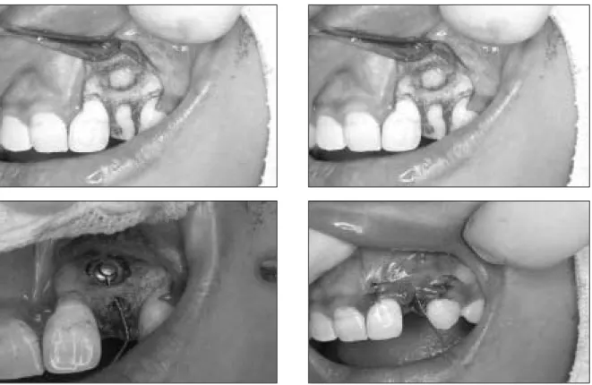 Fig. 2. Crown exposure by flap operation and button attachment to exposed canine(case 1).