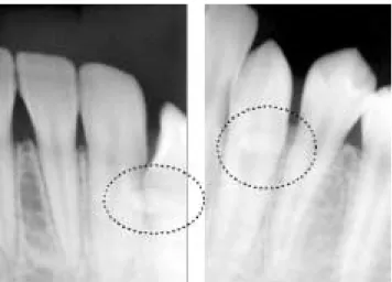 Fig. 6. Tiny odontoma was removed by flap operation(case 2).