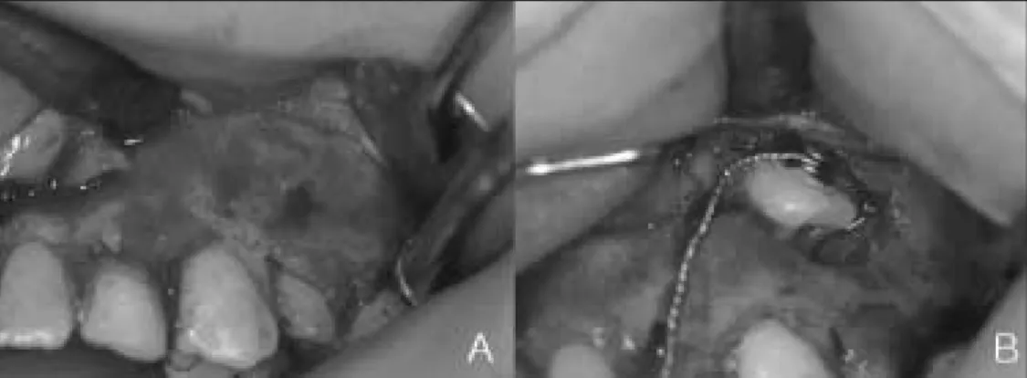 Fig. 4. Surgical exposure(A) and bonding of a button to the canine(B). 