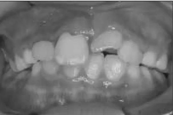 Fig. 1. Intraoral view : First visit.
