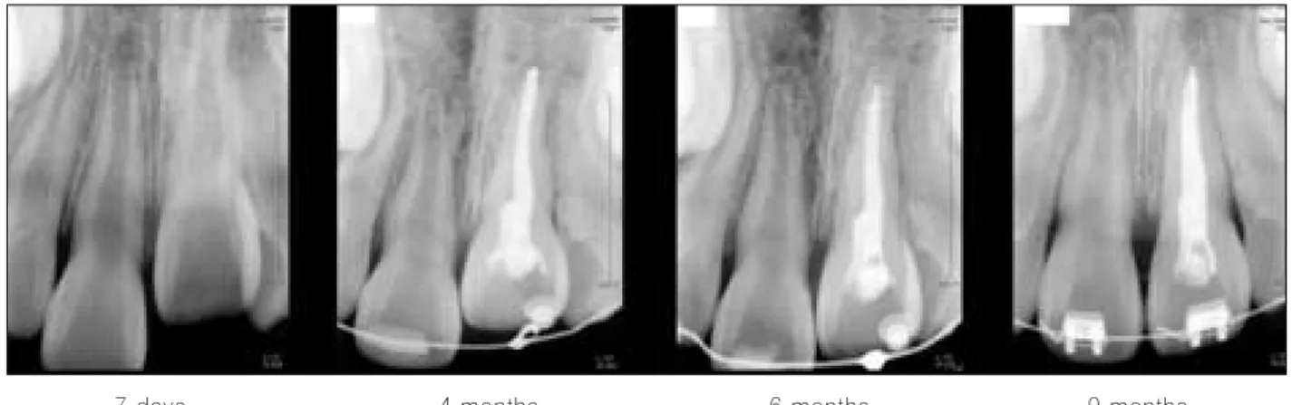 Fig. 5. 2 months after leveling and alignment.
