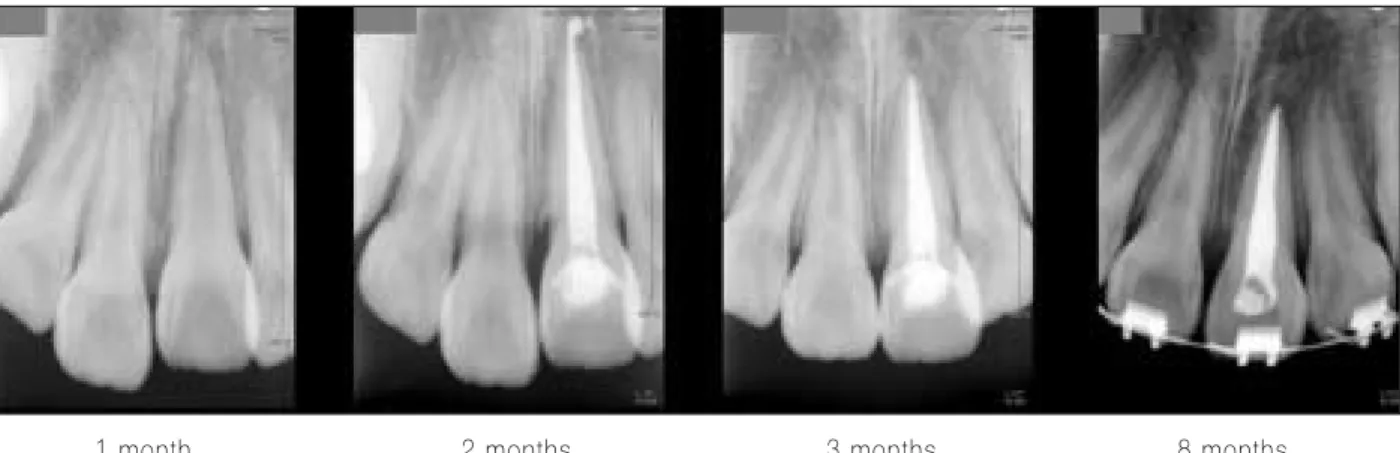 Fig. 8. Periapical radiograph after trauma.