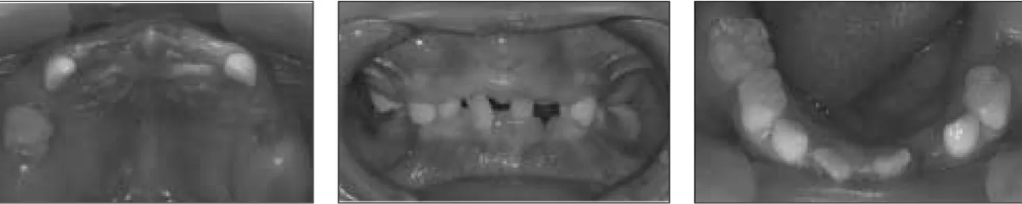 Fig. 2. Intraoral photographic view at 1st visit.