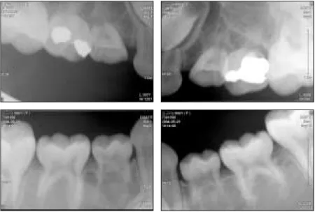 Fig. 3. Panoramic view  Fig. 2. Periapical view at the first visit 