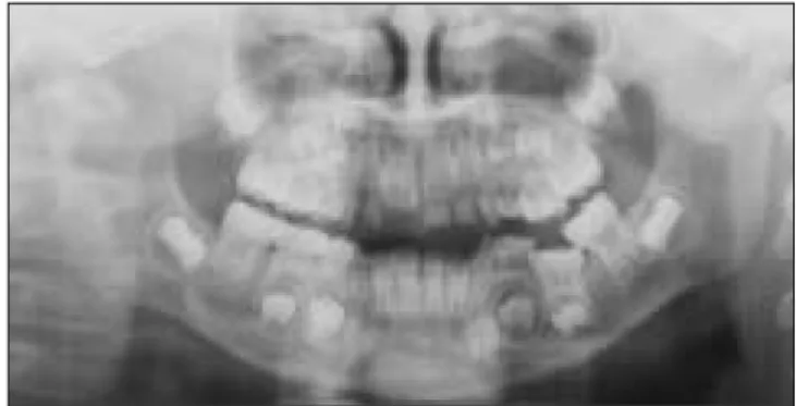 Fig. 3. Placement  of  space  regainer  before  extraction  of infraoccluded teeth