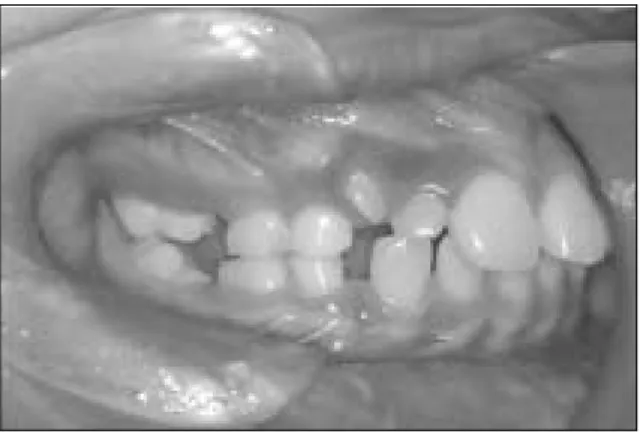 Fig. 7. Placement of space-regainer          Fig. 8. Panoramic view of 6 months after extraction 