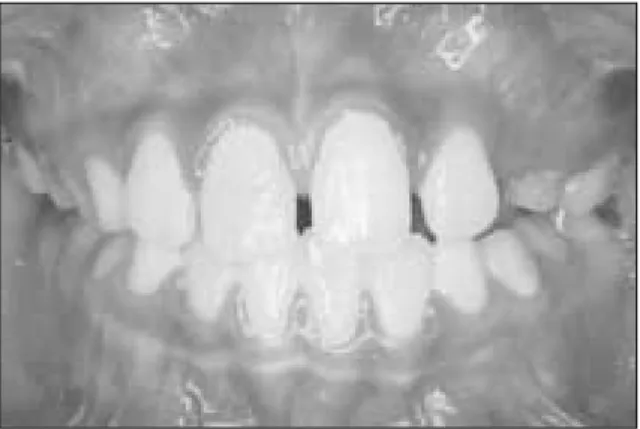 Fig. 1. Intraoral view at first visit.   Fig. 2. Marking  the  distribution  line  &amp;  block  out(frontal view).