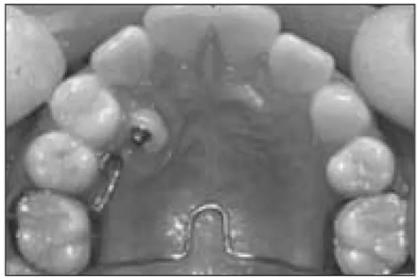 Fig. 1. Initial radiographic view Fig. 2. Orthodontic  traction  of  #13  with  lingual  button bonded on the palatal surface