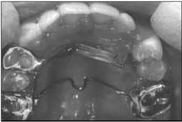Fig. 6. Initial radiographic view      Fig. 7. Orthodontic  traction  of  maxillary  left  canine  by elastic and fixed appliance