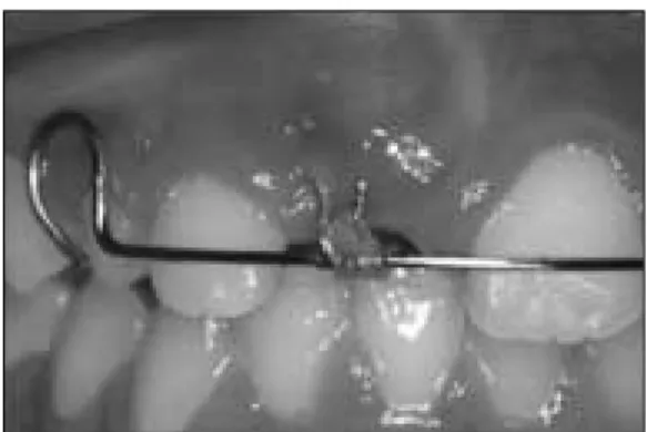 Fig. 13. Orthodontic  traction  of  maxillary  right  canine by elastic and removable appliance