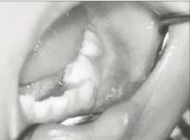 Fig. 3. Initial panoramic radiograph. Fig. 4. Initial occlusal radiograph.