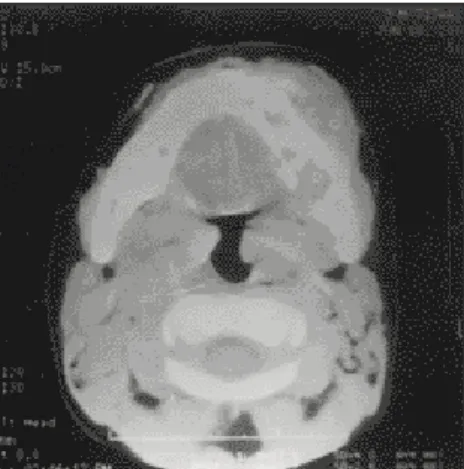 Fig. 9. Panoramic radiograph after chemotherapy.