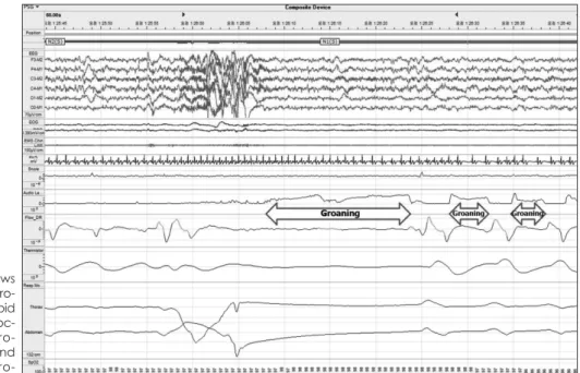 Figure 1. 60-second epoch shows  groaning sounds related with  pro-longed expiration during non-rapid  eye movement (NREM) sleep