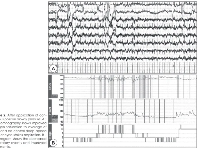 Figure 2. After application of con- con-tinuous positive airway pressure. A :  Polysomnography shows improved  oxygen saturation to average of  94% and no central sleep apnea  with cheyne-stokes respiration