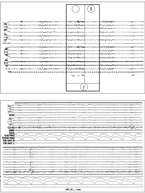 Fig. 1. An example of cyclic alter- alter-nating pattern (CAP) in a sleep stage 2. The box outlines a CAP cycle  (C) composed of a phase A  (A) and the following phase B (B)