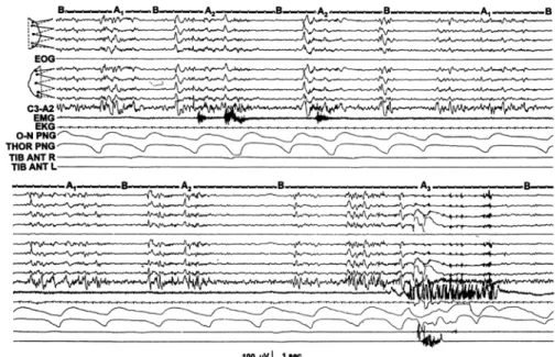 Fig. 3. A CAP sequence including all subtypes of phase As (Terzano et al., 2002). 