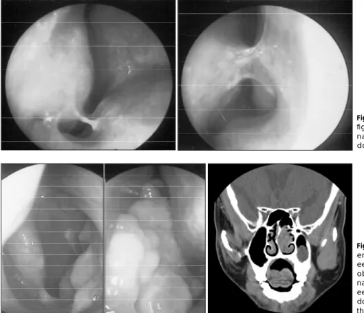 Fig. 1. Nasal septal deviation. Left figure is endoscopic view of right nasal cavity and right figure is  en-doscopic view of left nasal cavity.