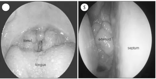 Fig. 1. Tonsillar hypertrophy and adenoid vegetation.  A：Oropha-ryngeal inlet is obstructed by huge  tonsils