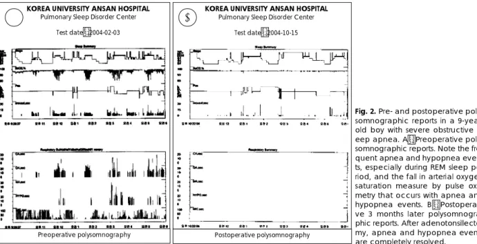 Fig. 2. Pre- and postoperative poly- poly-somnographic reports in a  9-year-old boy with severe obstructive  sl-eep apnea