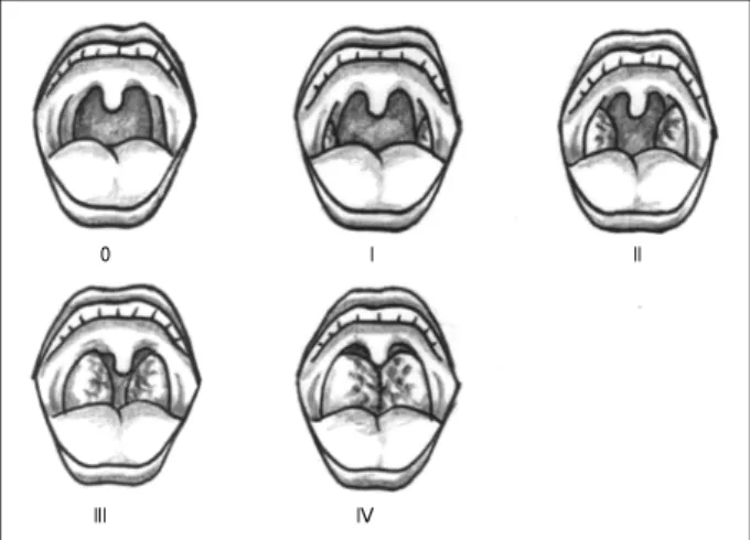 Fig. 2. Illustration of tonsil grades：Grade 0, Grade I, Grade II,  Grade III and Grade IV
