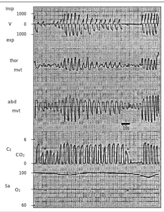 Fig. 3. Typical breathing pattern during REM sleep. For abbrevia- abbrevia-tion, see Fig