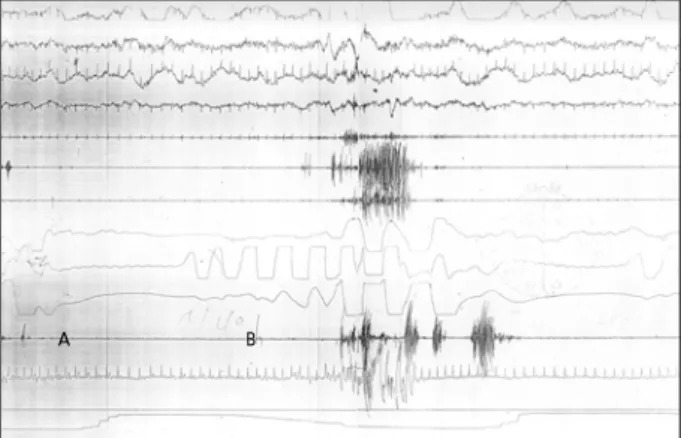Fig. 1. Polysomnographic finding. A：central apnea, B：obs- B：obs-tructive apnea, A and B：mixed type sleep apnea