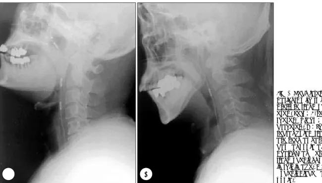 Fig. 1. Neck lateral x-ray of  patients with two kinds of  pressure transducer  cath-eter (Left；4-sensor  ca-theter, Right ； 2-sensor  catheter)