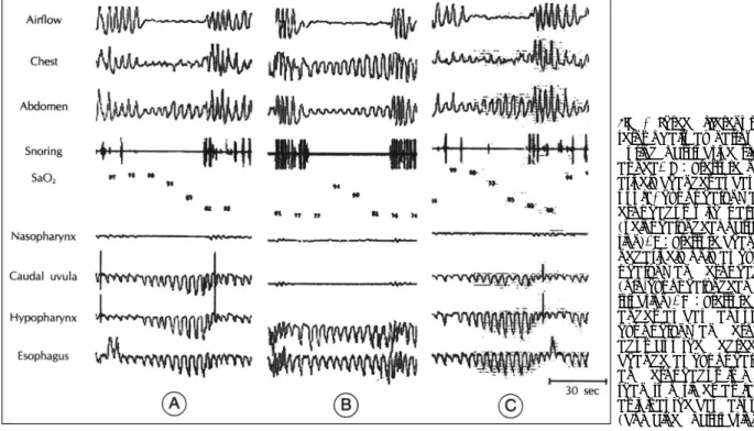 Fig. 2. Three different pat- pat-terns of airway narrowing  during obstructive sleep  apnea
