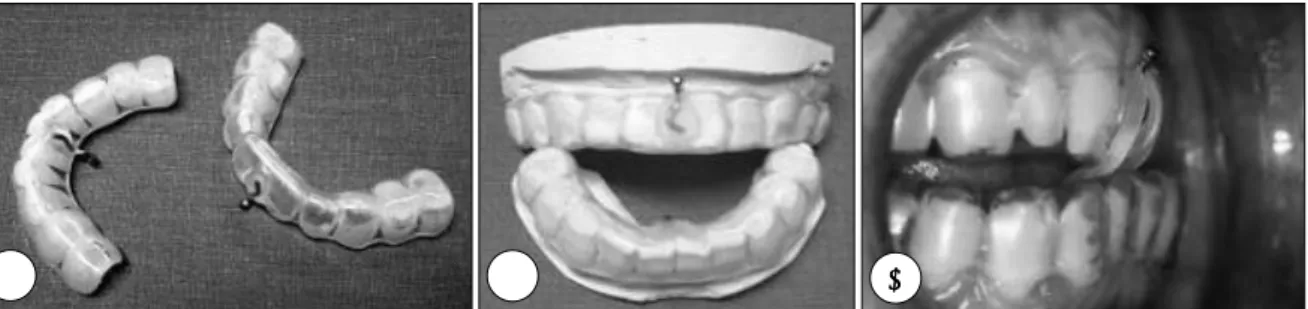 Fig. 2. A：Upper(right) and low(left) parts of MRD, B：MRD worn on teeth molding, C：MRD is worn on patient's teeth  (mandibular teeth were advanced by elastic band hooked over a metal ring of upper part of MRD)