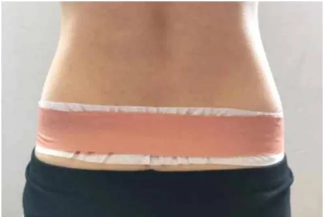 Figure  2.  Non-elastic  taping  applied  to  the  pelvis  area