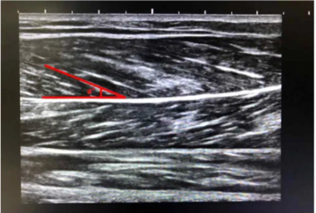 Figure  1.  The  pennation  angle  of  the  medial  gastrocnemius(a)