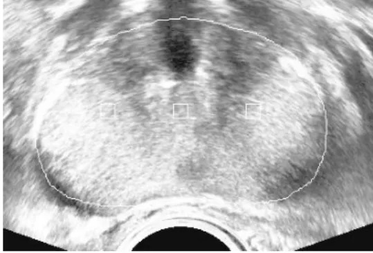Fig. 11. Prostate distribution after comparing sample  prostate blocks and other blocks