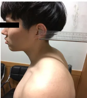 Figure 1. Measure of with forward head posture