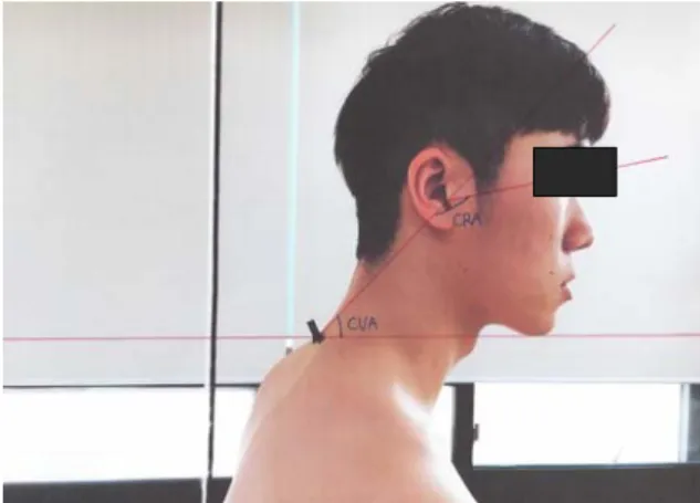 Figure  1.  Measurement  of  craniovertebral  angle  and  cranial  rotation  angle