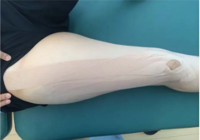 Fig  1.  Kinesio  taping  applied  condition