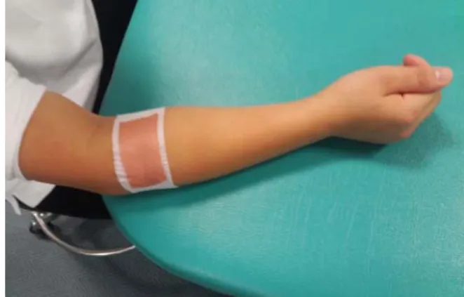 Fig 1. Mobilization with movement taping