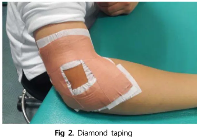 Fig 2. Diamond taping    