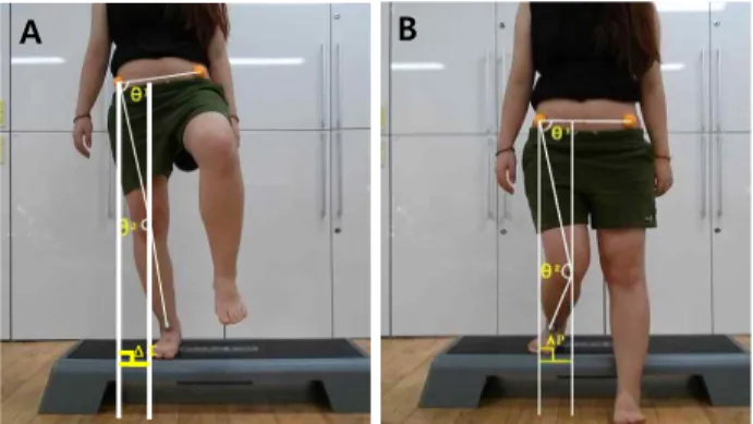 Fig  1.  Valgus  collapse  knee  position  during  single  limb  stance  task.  (A)  Static  phase,  (B)  Dynamic  phase 