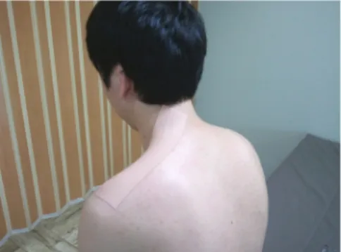 Fig  1.  Upper  trapezius  taping