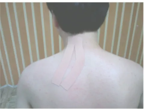 Fig  2.  Levator  scapulae  taping 푸시업  플러스와  테이핑  적용군은  일반적  물리치료  적용  후  승모근  상부와  견갑거근에  테이핑을  적용한  후  푸시업  플러스  운동을  15분간  자가로  시행하였다