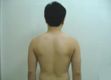 Fig  1. Lateral  scapular  slide  test 