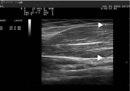 Fig  6.  Sonography  for  the  diameter  of  Biceps  brachii  on  contracted  (female)