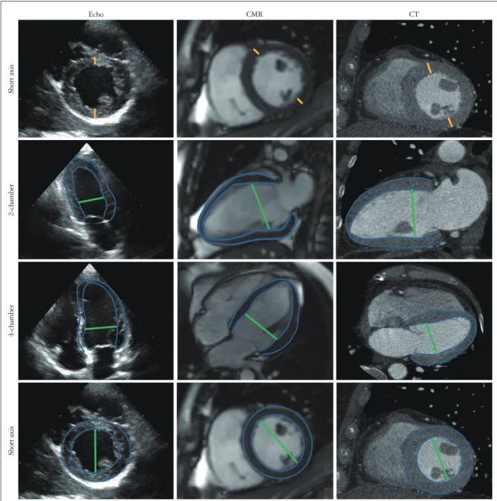 Fig. 1. Methodology for the measurement of the septal and posterior wall thickness, LV mass, and LV diastolic diameter with echo, CMR and CT
